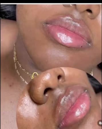 Pink Lips Enhancement