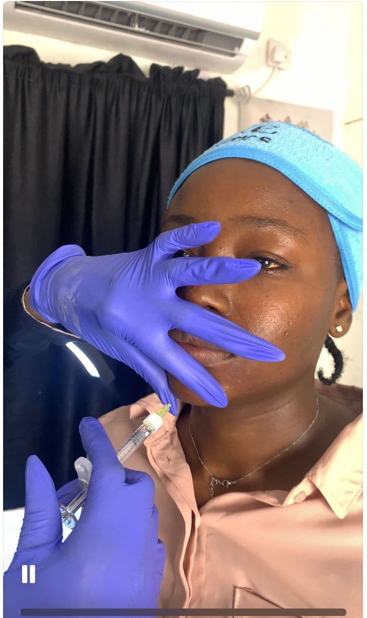 Chin Filler Enhancement