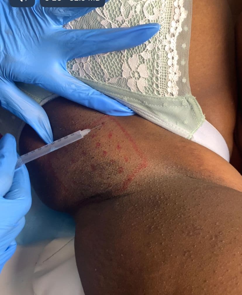 Botox for Excessive Sweating