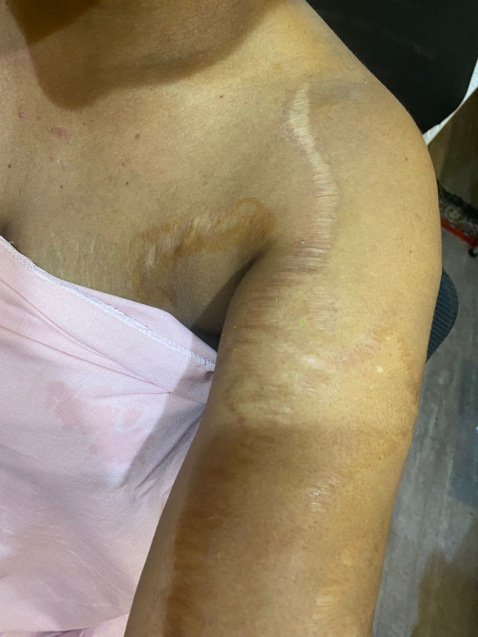 Stretch Marks Treatment